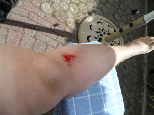 My knee after half an hour