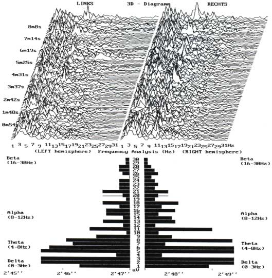 Graph showing how Tachyon Energy balances the brain